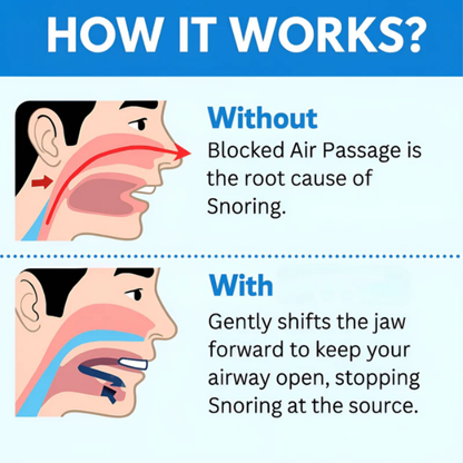 Zentrio® Anti-Snoring Mouthpiece